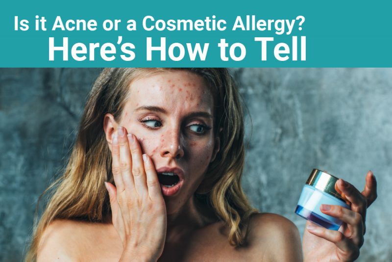 Is it Acne or a Cosmetic Allergy? Here’s How to Tell Tottori Allergy